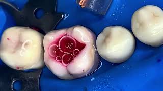 Cleaning Up Occlusal Decay On Teeth On A Molar