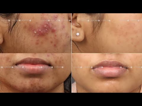 அதிக முகப்பரு வருவதை எப்படி தவிர்க்கலாம் / Tips to Treat pimples