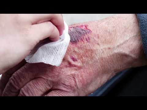 Blood Infection | Symptoms, Signs, Causes, and Treatment