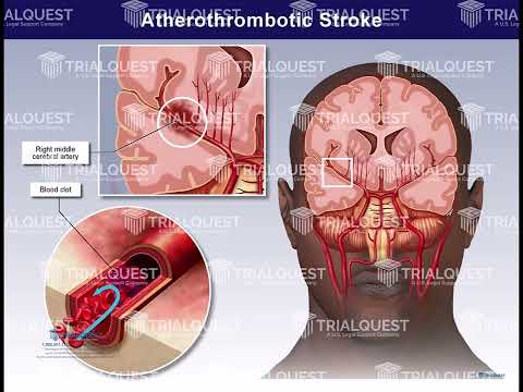Atherothrombotic Stroke & Incarcerated Umbilical Hernia