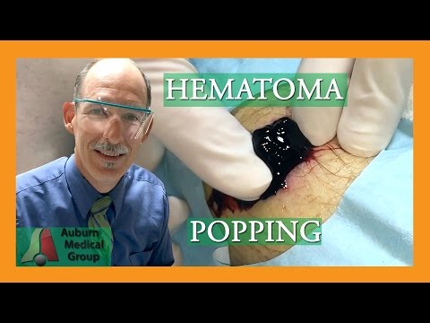 Hematoma Popping | Auburn Medical Group