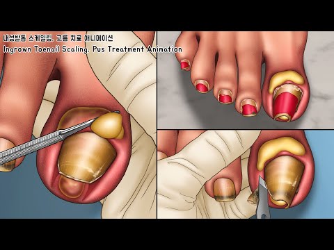 ASMR 오랫동안 방치된 내성발톱과 고름 깨끗하게 치료하기! 발톱 스케일링 애니메이션 | Ingrown Toenail removal treatment animation