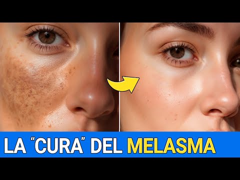 Elimina el MELASMA de forma natural y ¡SIN EFECTO REBOTE!