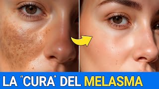 Elimina el MELASMA de forma natural y ¡SIN EFECTO REBOTE!