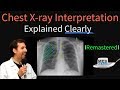Chest X-Ray Interpretation Concepts