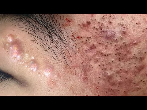 Big Cystic Acne Blackheads Extraction Blackheads & Milia, Whiteheads Removal Pimple Popping # 8706