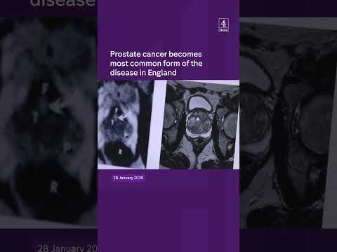 Prostate cancer most common cancer