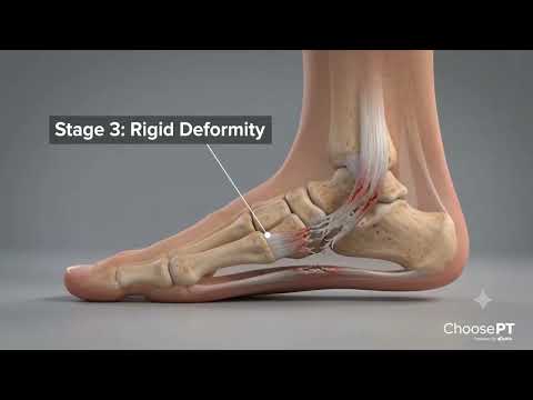 4 Stages of Flat Feet Everyone Should Know | Expert Foot & Ankle Advice