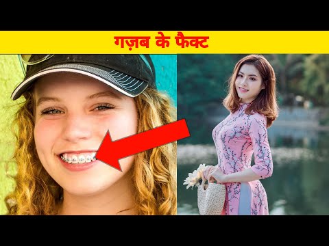 दातों पर तार क्यों लगाया जाता है? #ytshorts #shorts #india