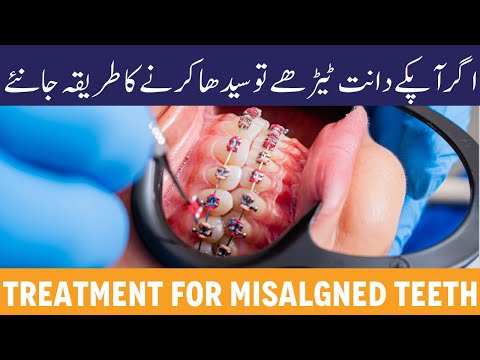 Tedhe Danto Ko Seedha Karne Ka Tarika - Misaligned/Crooked Teeth Treatment - Best Age To Get Braces