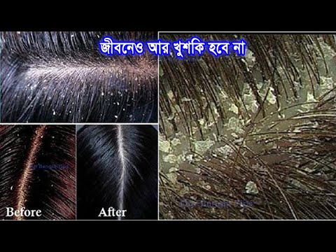 আর খুশকি হবে না ১ বার এটা গোসলের আগে লাগিয়ে দেখুন।খুশকি দূর করার তেল/dandruff solution