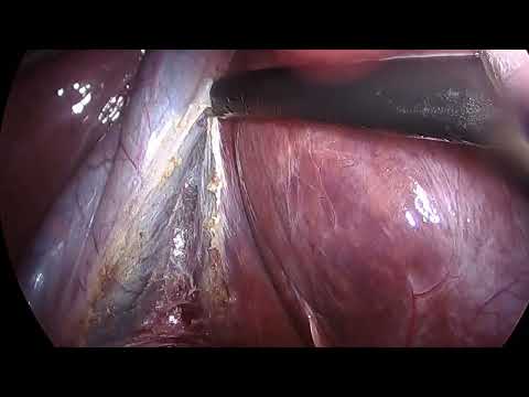 Colecistectomia laparoscópica/ Laparoscopic cholecystectomy