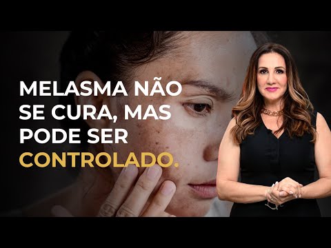 MELASMA NÃO É TUDO IGUAL: CONHEÇA O SEU E TRATE COM PRECISÃO