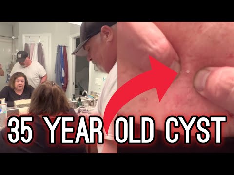 35 YEAR OLD Cyst | Satisfying HARD POP and BLACKHEAD Removal | #TheBubbaArmy