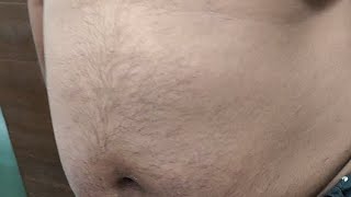 Live Gynecomastia surgery Planning