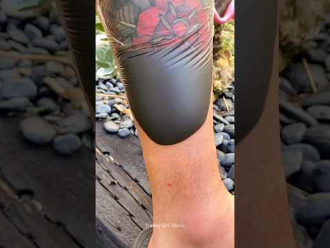 Tattoo Ink Sack In Skin