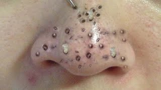 Blackhead Removal With Sac Dep Spa @100074689