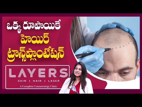 One Rupee Hair Implantation at Layers Skin & Hair Clinic | Dr Suvidha Gandra MD Dermatologist