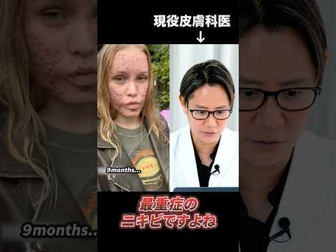 最重症のニキビ治療について現役皮膚科医が解説#shorts