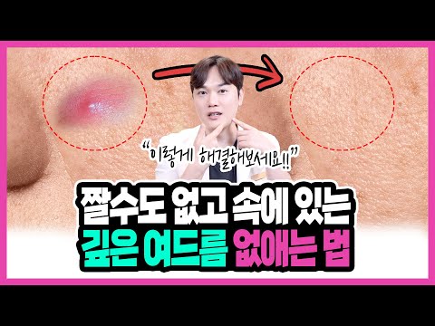 속에서 만져지기만 하고 짤수도 없는 여드름 해결하는방법! 좁쌀여드름, 화농성여드름, 모낭염, 깊은여드름 전부 알려드려요!