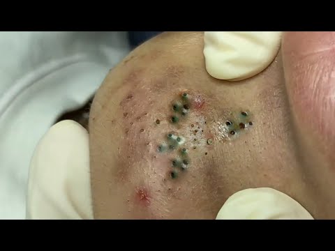 Big Cystic Acne Blackheads Extraction Blackheads & Milia, Whiteheads Removal Pimple Popping # 3915