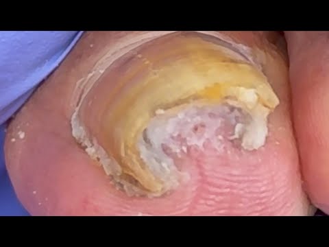 Highlight Curly Ingrown Toenails! Solve Foot Problems【Xue Yidao】