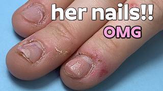 Watch Me Transform These Severely Bitten & Short Nails