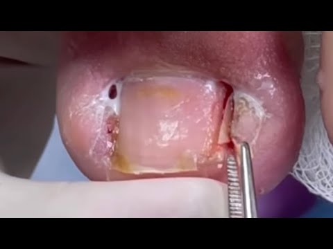 ELA PENSOU QUE SÓ ERA UM PEDAÇO PEQUENO DE UNHA,Mas Quando Puxou Olha Isso 😷 Pódologia Podo Penha