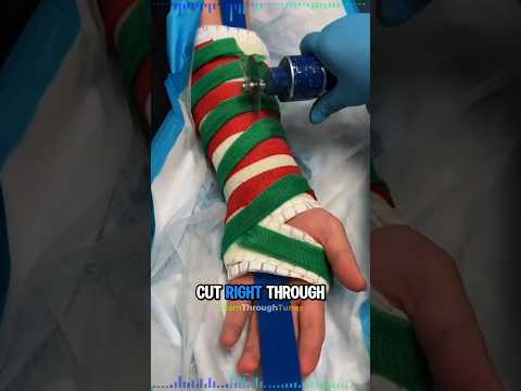How Doctors Remove Casts Without Cutting You 🩺🤯