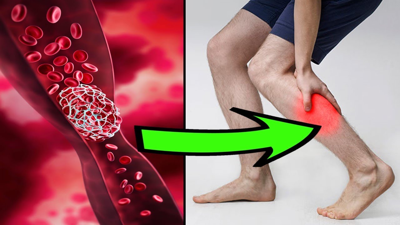 How to Prevent Blood Clots Naturally￼