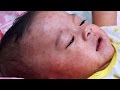Measles Outbreak and Vaccination Impact