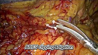 Laparoscopic Transverse Colectomy | Step-by-Step Surgical Procedure & Operative Technique