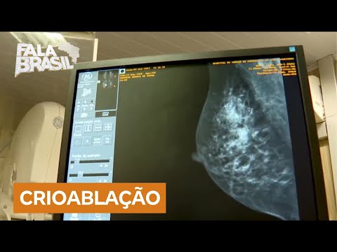 Crioablação: tratamento inovador para câncer de mama mostra resultados promissores no Brasil