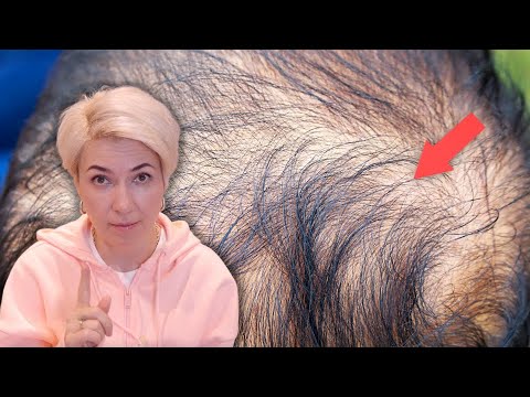 Выпадение волос | Как избавиться от выпадения волос в домашних условиях | Профилактика седины