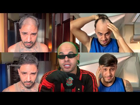 homens disfarçando a calvíce