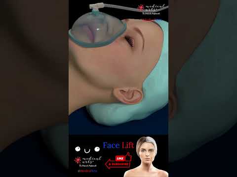 Face Lift Surgery - Medical Arts Animations
