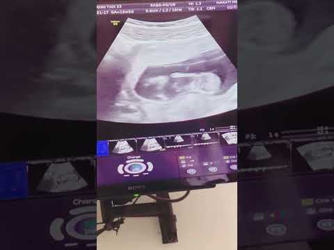 Kris Bernal masayang nakita ang baby niya sa ultrasound 😍🥰
