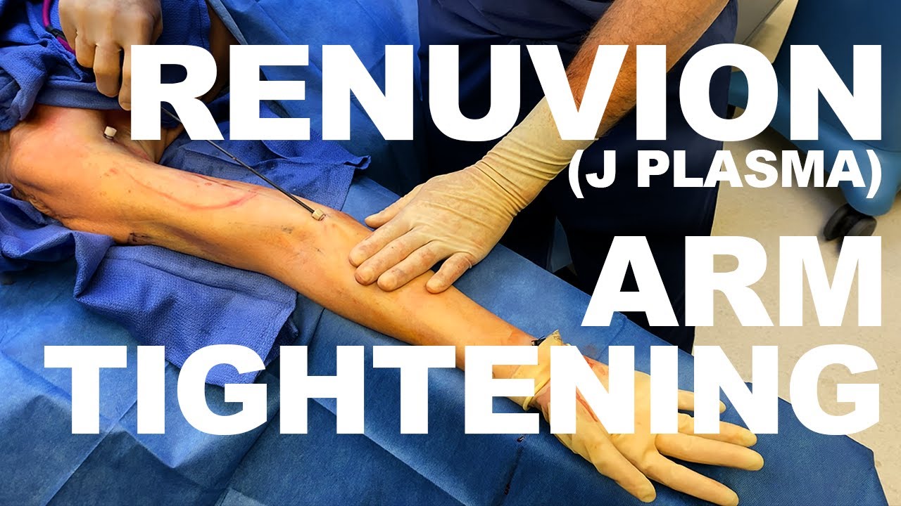 Arm tightening procedure with Renuvion technology.
