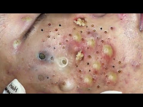 Blackheads & Acne Treatment Latest Update 27102023