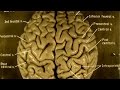 Einstein's Brain: A Study in Anatomy
