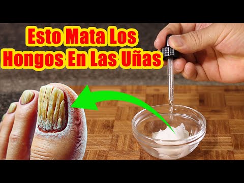 Esto MATA LOS HONGOS EN LAS UÑAS RAPIDAMENTE | Remedio Casero Para ELIMINAR HONGOS En Las Uñas