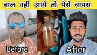 Hair growth oil for fast hair growth | Hair regrowth tips | बाल नहीं आए तो पैसे वापस 110% गारेंटी