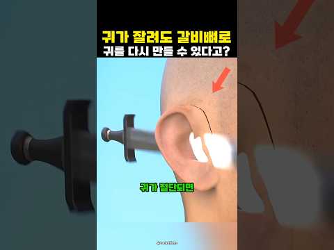 다친 귀를 갈비뼈를 사용해서 복구하는 방법?