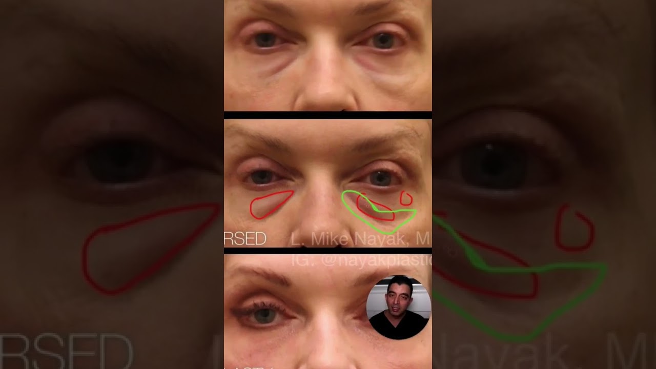 Before and after cosmetic procedure eye comparison.