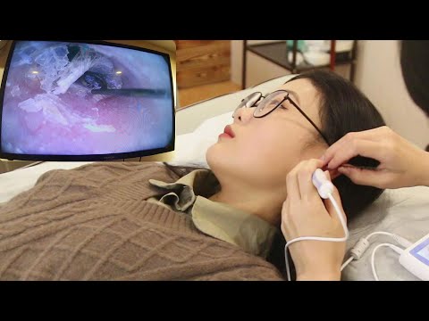 【ASMR】Experience the most professional visual earwax cleaning and relaxing ear massage！
