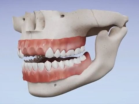 Essix Partial Denture Retainer – Dental Lab Direct