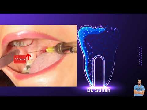 فيديو مبسط لزملائي واعزائي الطلاب عند كيفية تخدير الفك السفلي inferior alveolar nerve block