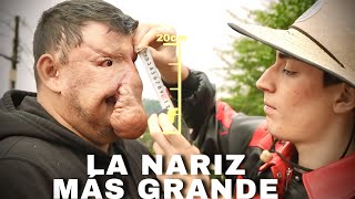 24 HORAS TRANSFORMANDO AL HOMBRE CON LA NARIZ MAS GRANDE DEL MUNDO