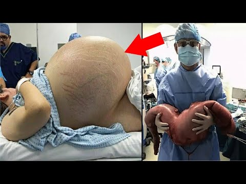 10 COISAS MAIS ESTRANHAS RETIRADOS DE DENTRO DE UMA PESSOA