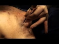 Needle Thoracentesis and Chest Tubes